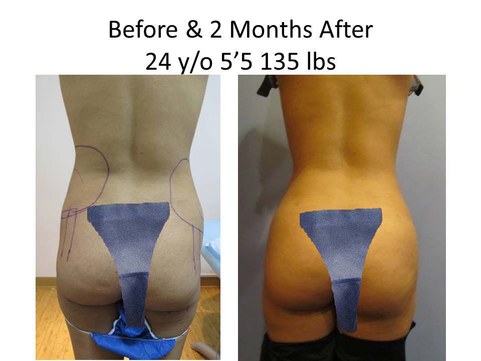 Brazilian Butt Lift Before and After Photo 11
