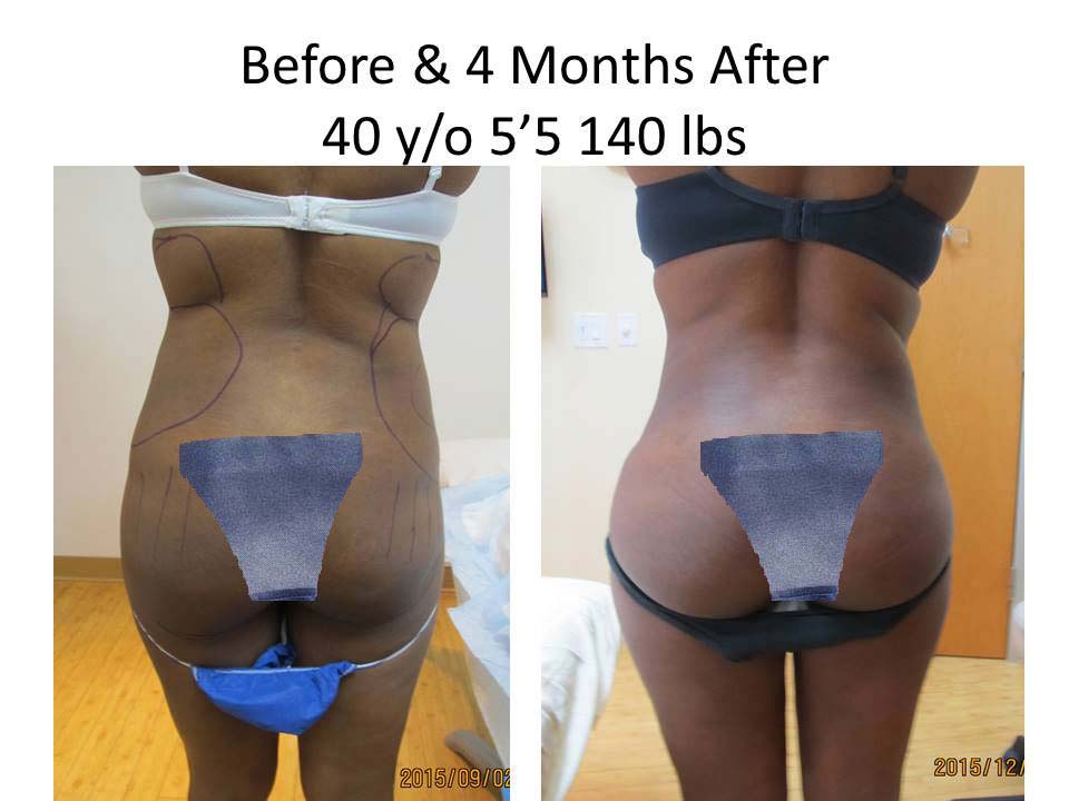 Brazilian Butt Lift Before and After Photo 13