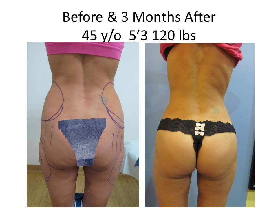 Brazilian Butt Lift Before and After Photo 17