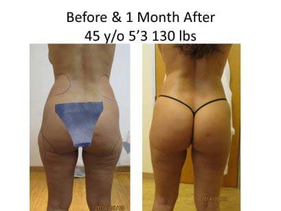 Brazilian Butt Lift Before and After Photo 19
