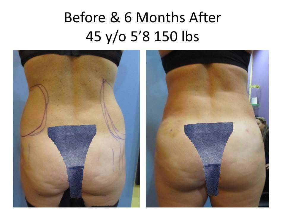 Brazilian Butt Lift Before and After Photo 3