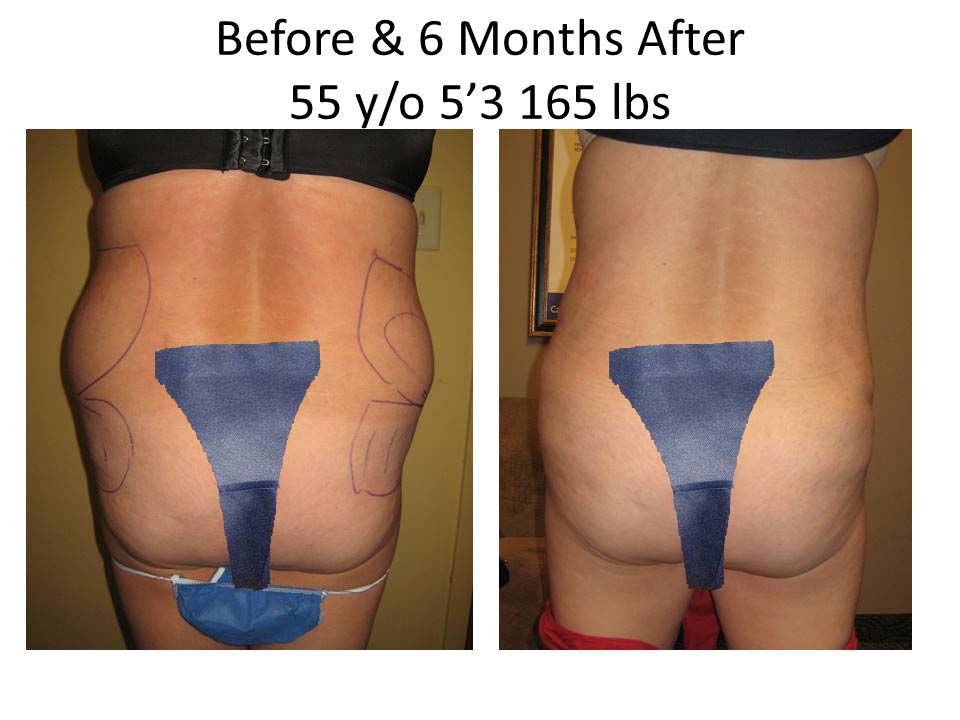 Fat Transfer to Buttock Liposuction Before and After Photo 15