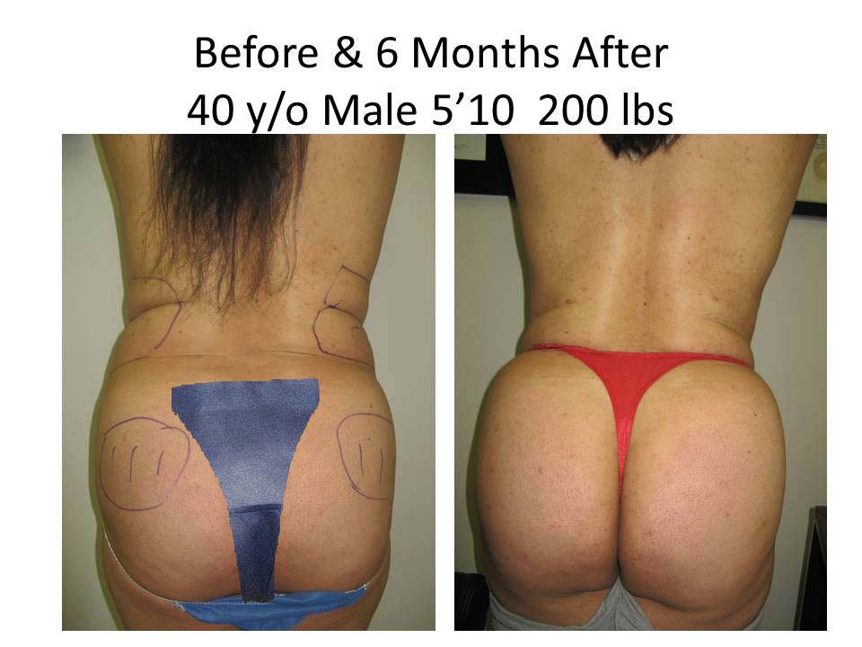 Fat Transfer to Buttock Liposuction Before and After Photo 6