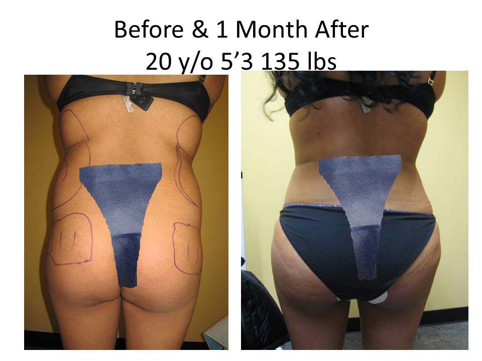 Fat Transfer to Buttock Liposuction Before and After Photo 8