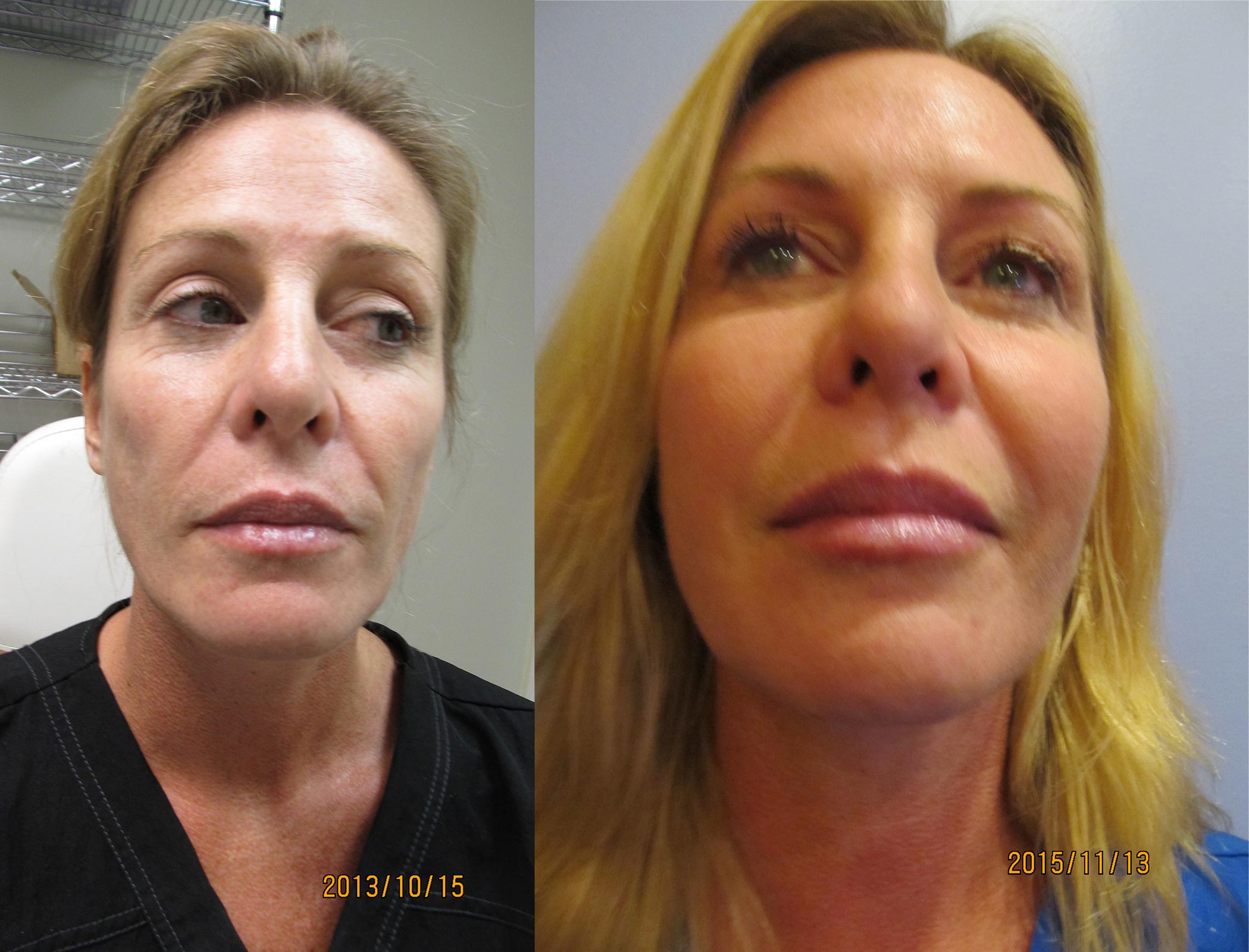 Fat Transfer to Face Before and After Photo 2