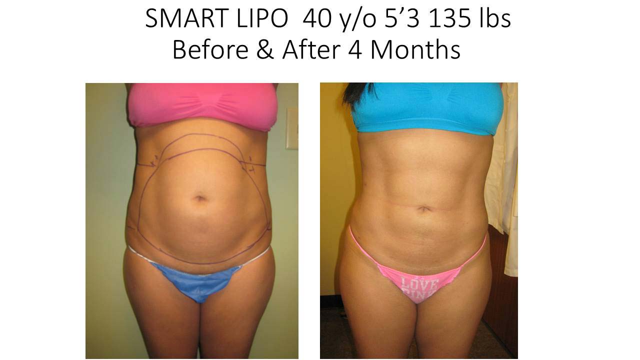 Liposuction Fat Removal Before and After Photo 13
