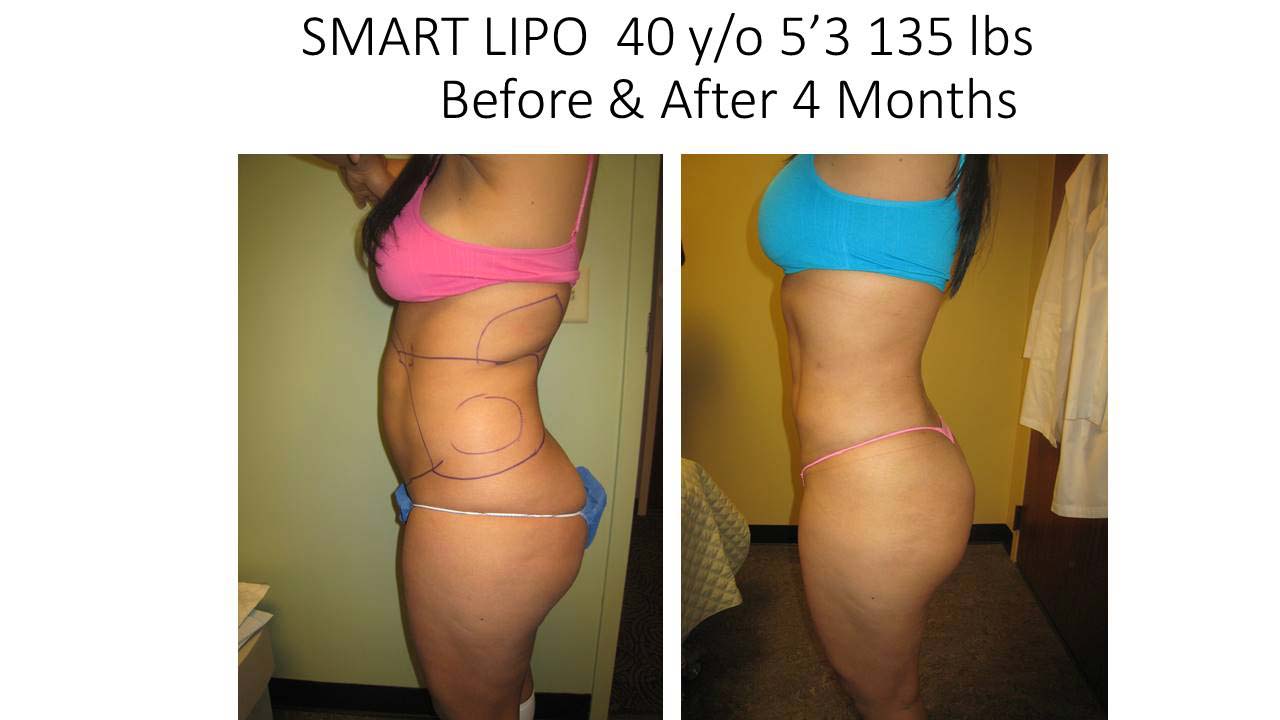 Liposuction Fat Removal Before and After Photo 14