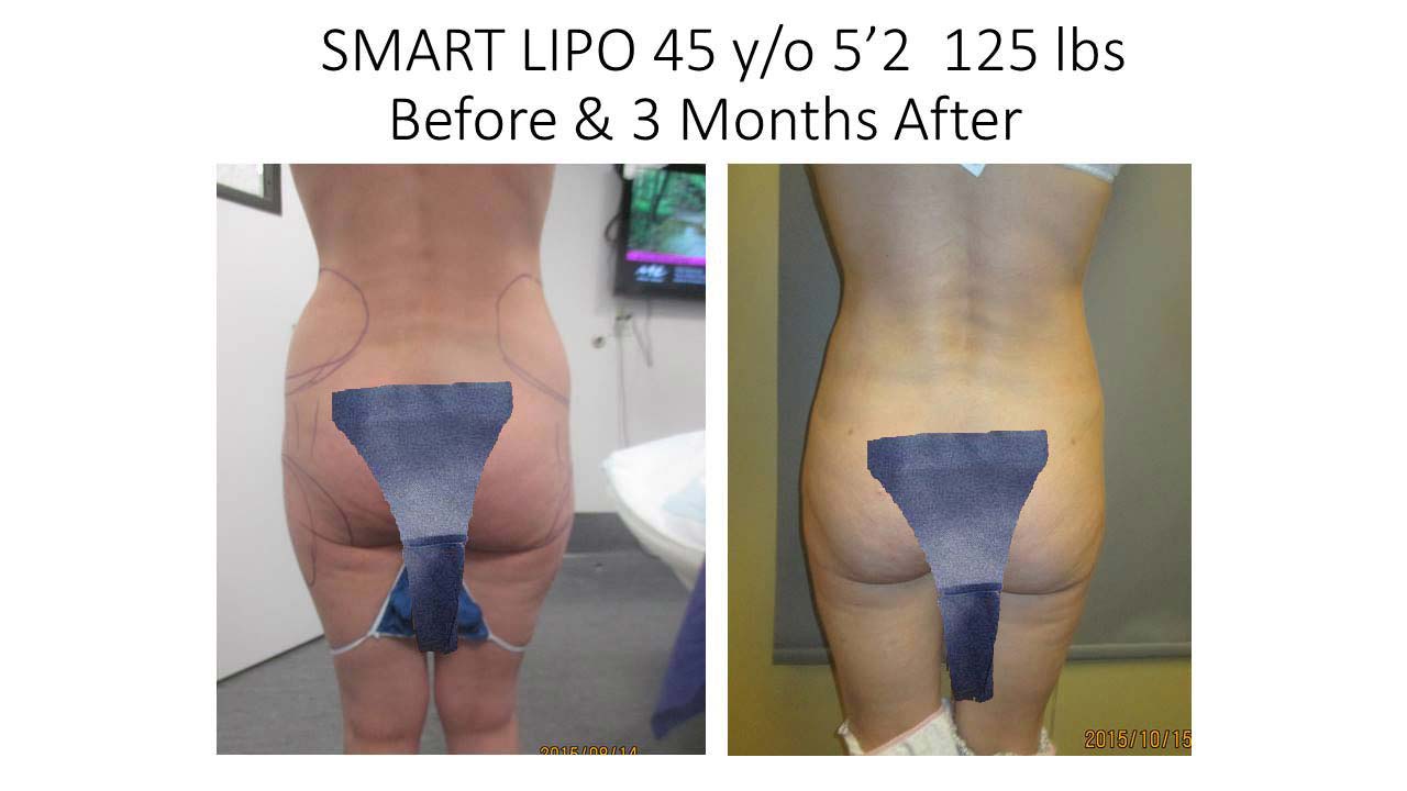 fat liposuction before removal transfer sculpting laser smart lipo results