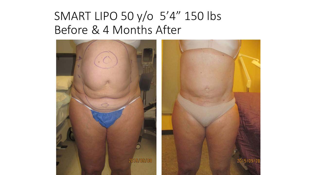 Liposuction Fat Removal Before and After Photo 8