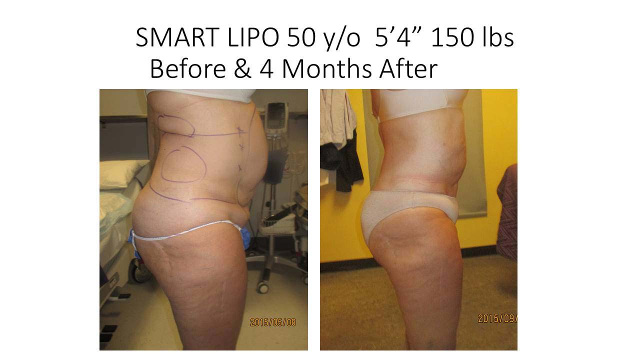 Liposuction Fat Removal Before and After Photo 9