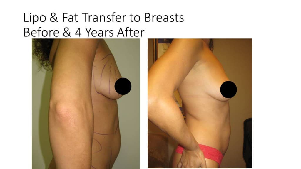 Liposuction Fat Transfer to Breasts Before and After 2