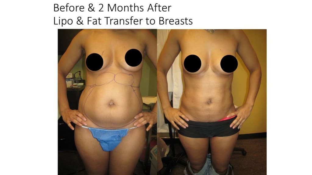 Liposuction Fat Transfer to Breasts Before and After 4
