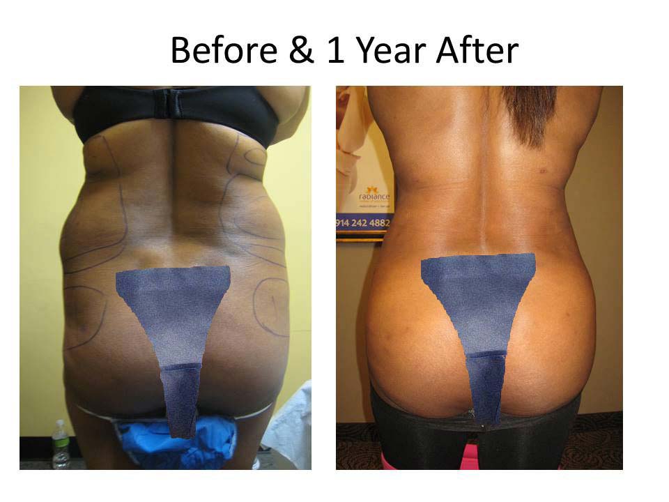 Fat Transfer to Buttock Liposuction Before and After Photo 2