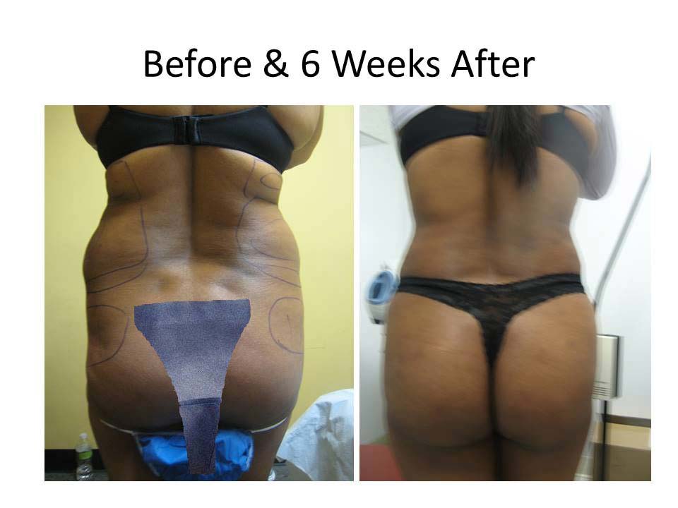 Fat Transfer to Buttock Liposuction Before and After Photo 4