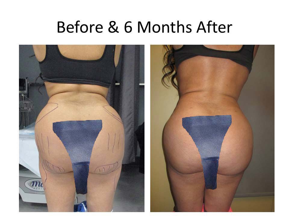 Fat Transfer to Buttock Liposuction Before and After Photo 7