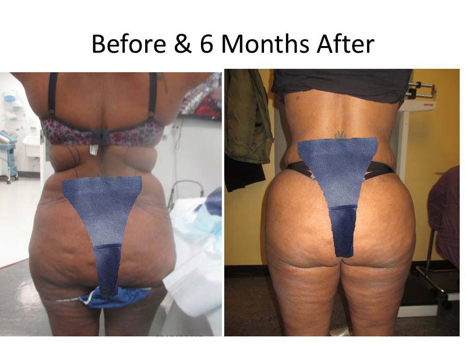 Fat Transfer to Buttock Liposuction Before and After Photo 9