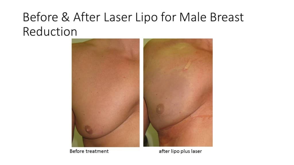 Male Breast Reduction Liposuction Before and After 7