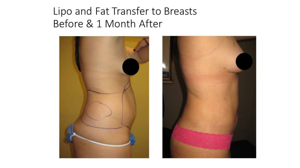 Natural Breast Augmentation Liposuction Before and After 1