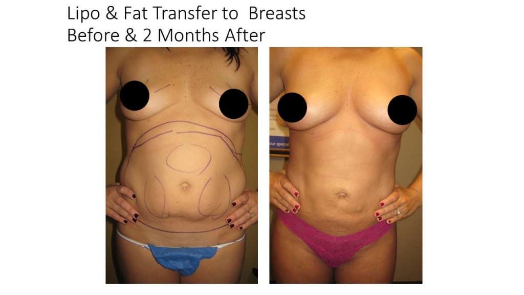 Natural Breast Augmentation Liposuction Before and After 2