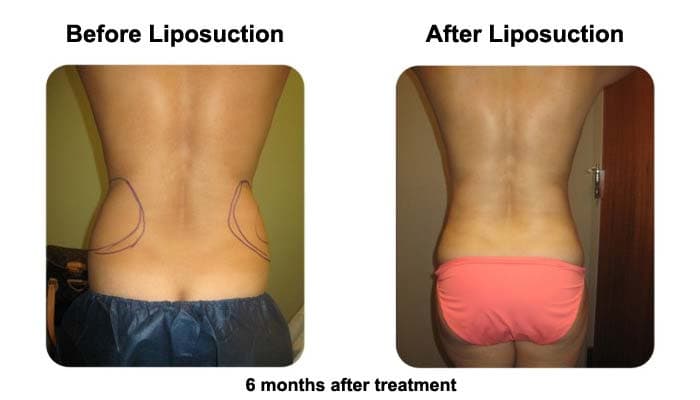 Smart Liposuction Back Before and After Photo 1