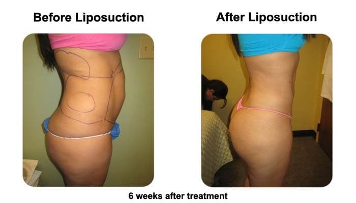 Smart Liposuction Side Before and After Photo 2