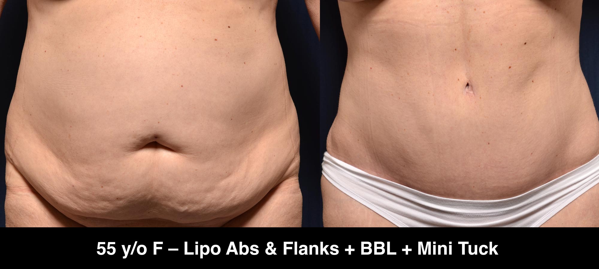 Large Volume Liposuction Female Abdomen 2