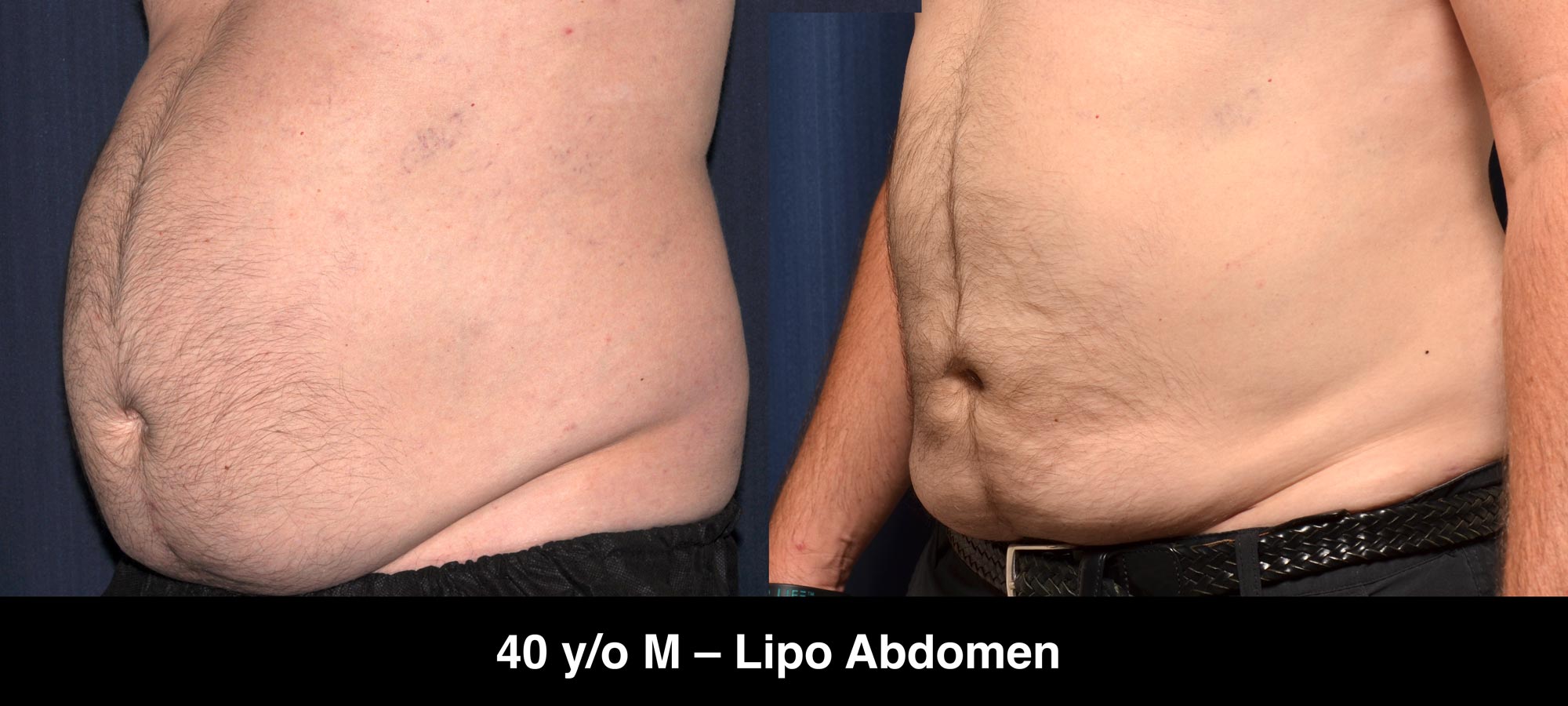 Large Volume Liposuction Male Abdomen