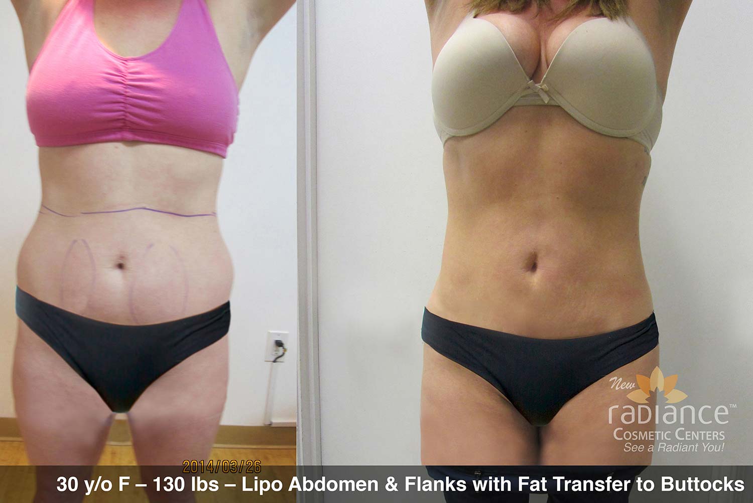 Abdomen and Waist Liposuction - Before and After Photos, flanks