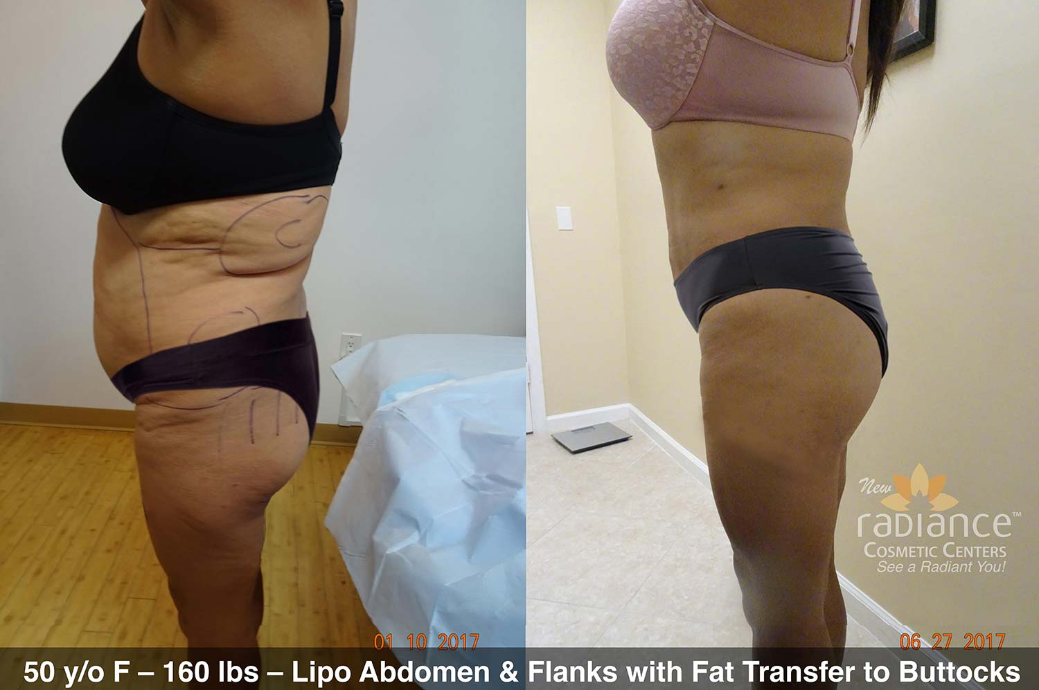Brazilian Butt Lift | Liposuction with Fat Transfer to Buttocks in Florida
