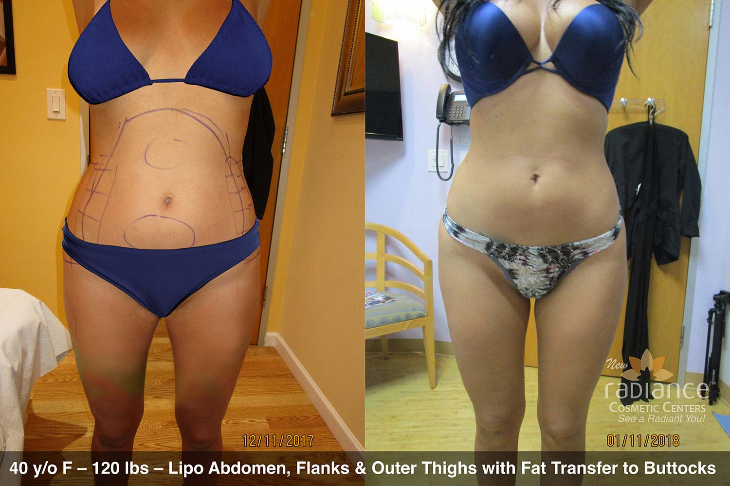 Smart Liposuction Before And After Photos